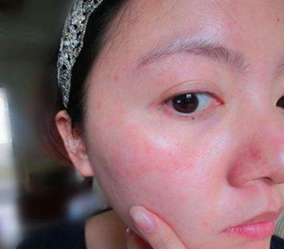 臉上皮膚過敏症狀