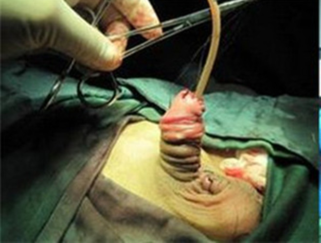 嬰幼兒先天尿道下裂