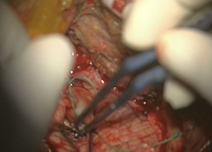 小腦腦梗塞手術