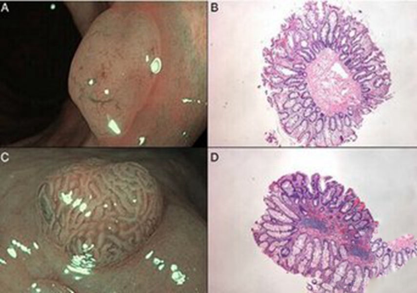 腫瘤腸腫瘤細胞圖
