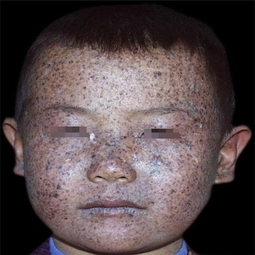 面頸部皮脂腺痣