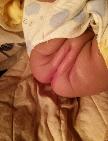 寶寶紅屁屁照片 (30) 