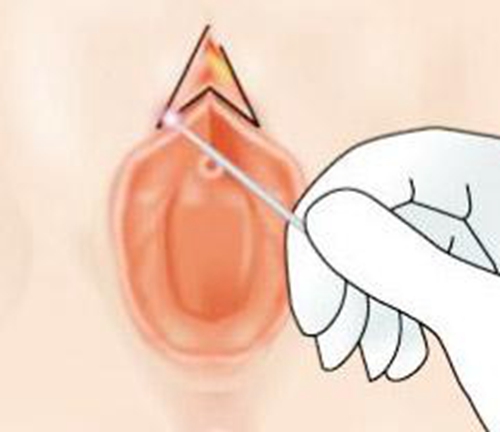 小陰唇肥大正常嗎