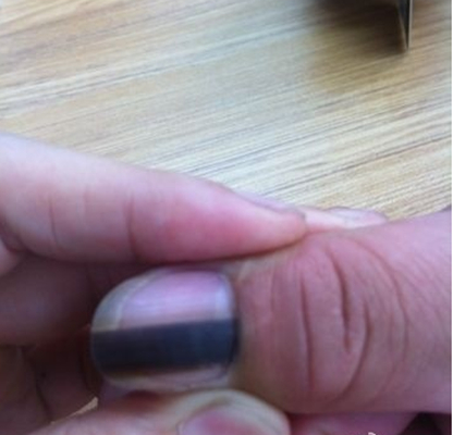 手指甲上有豎紋圖解 (46) 