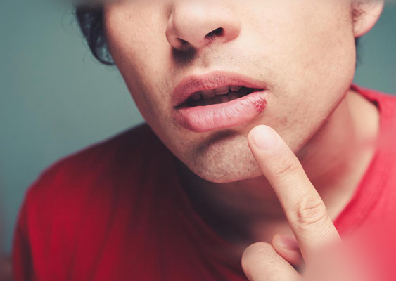 嘴上長皰疹 (43) 