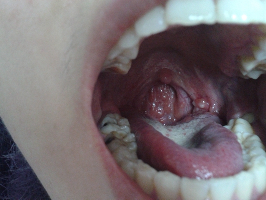 喉部淋巴濾泡增生 (9) 