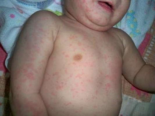 小兒猩紅熱症狀