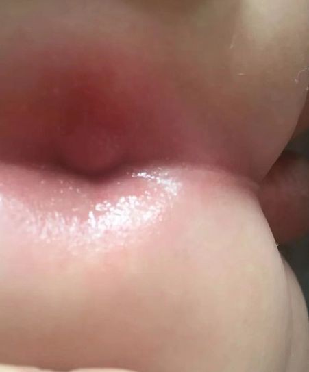 寶寶肛裂