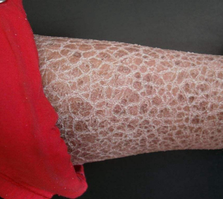 小腿皮膚像魚鱗 (54) 