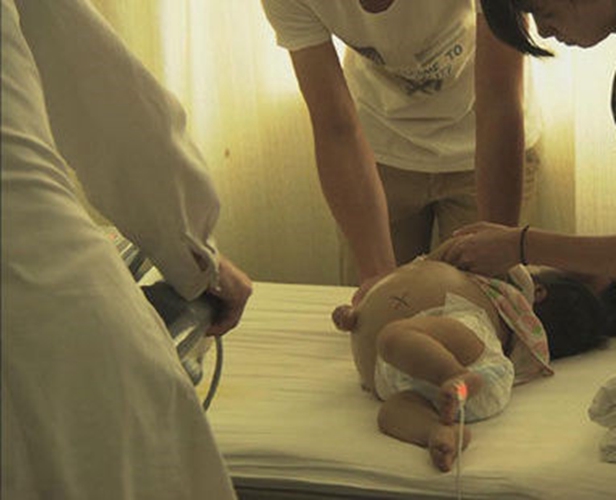 新生兒患有腹水