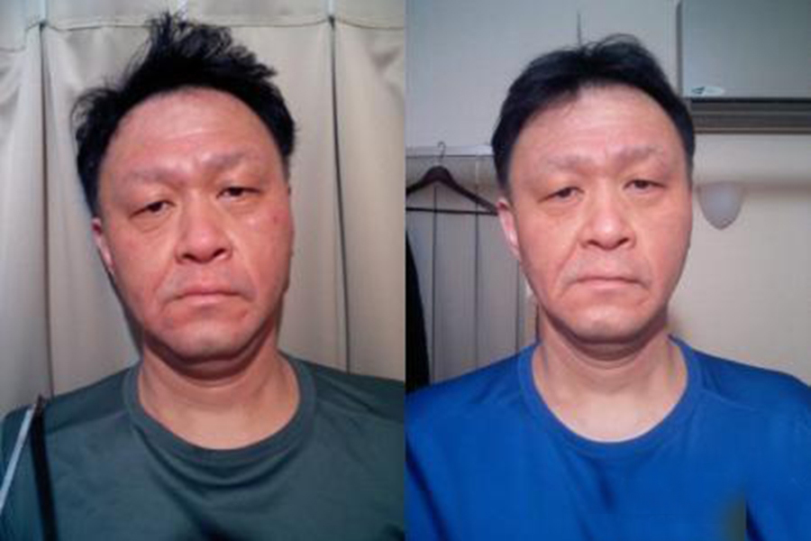 中年男性面肌痙攣治療前後對比