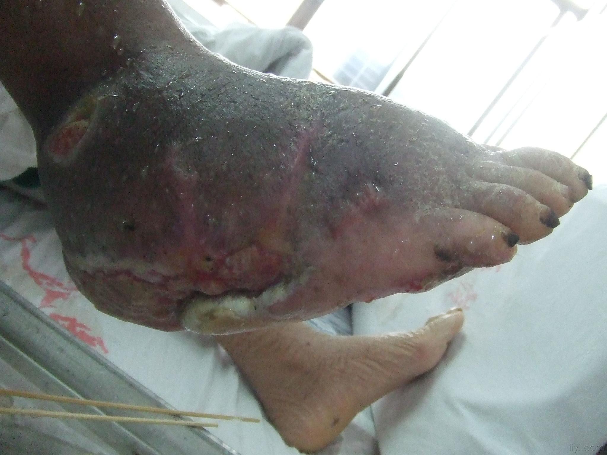 右腳糖尿病足