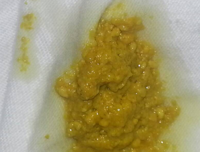 新生兒腹瀉大便