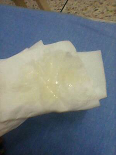 不正常精液液化