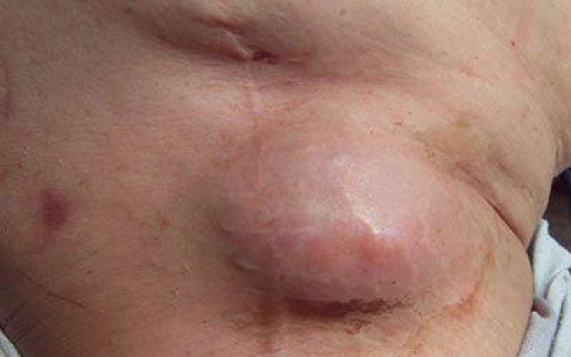 皮膚黃色瘤病腫大