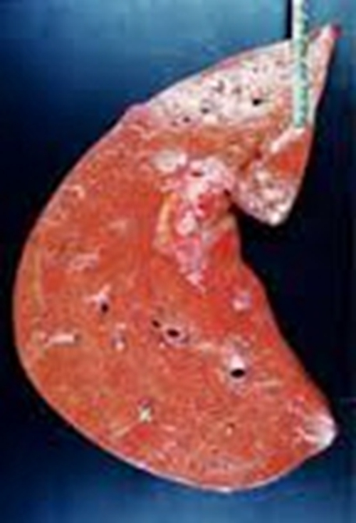  重度酒精肝併發症