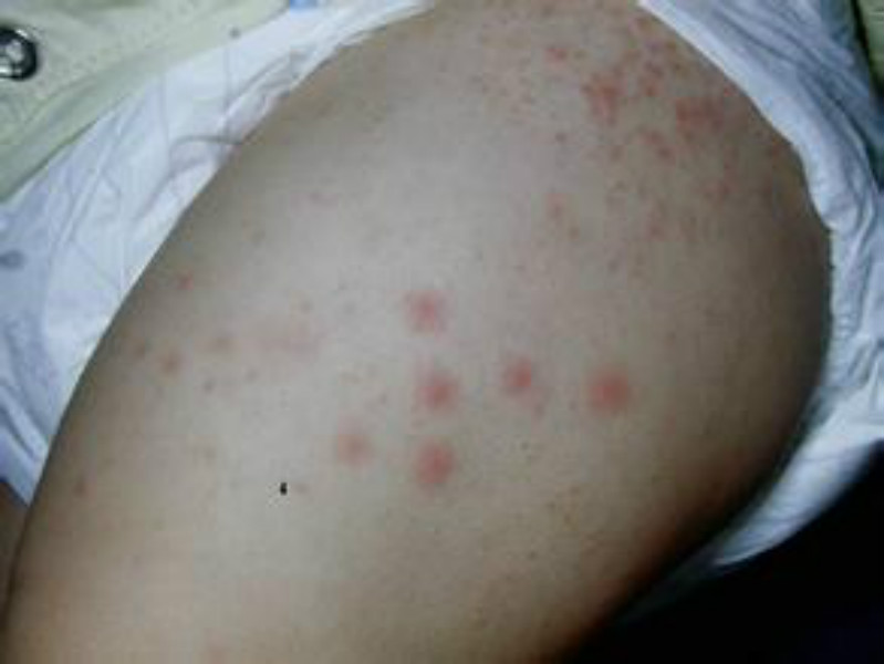 嬰兒胳膊皮膚念珠菌病