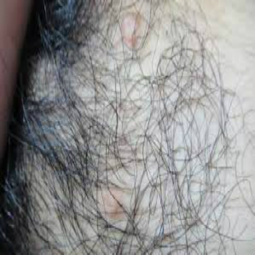 外陰溼疹症狀和