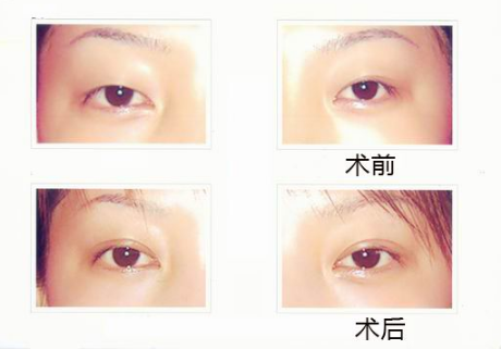 割雙眼皮
