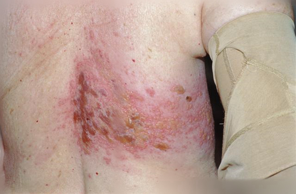 帶狀皰疹樣外觀