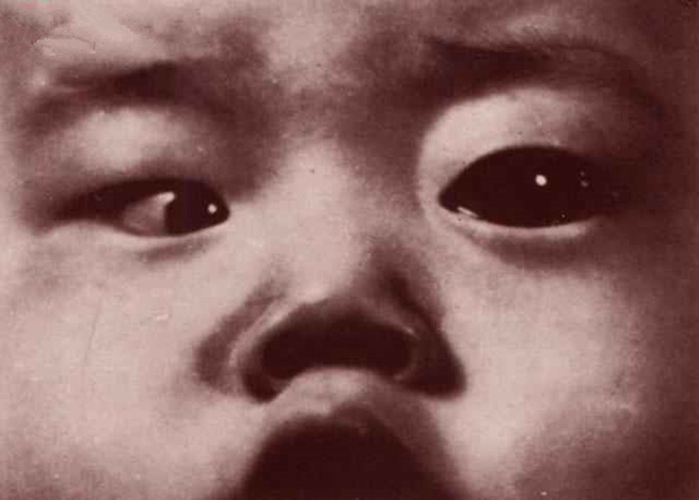 嬰幼兒性青光眼的