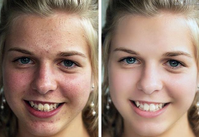 磨皮手術效果圖 (52) 