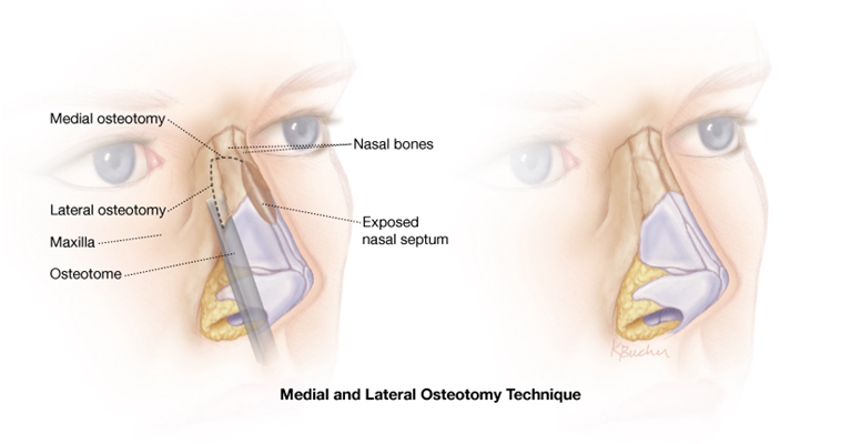鼻中隔彎曲手術圖解 (32) 