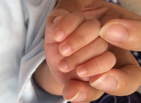 寶寶手上長水泡