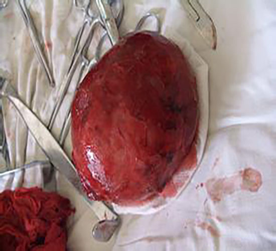 切除的甲狀腺瘤的