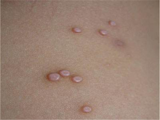 什麼是傳染性軟疣 