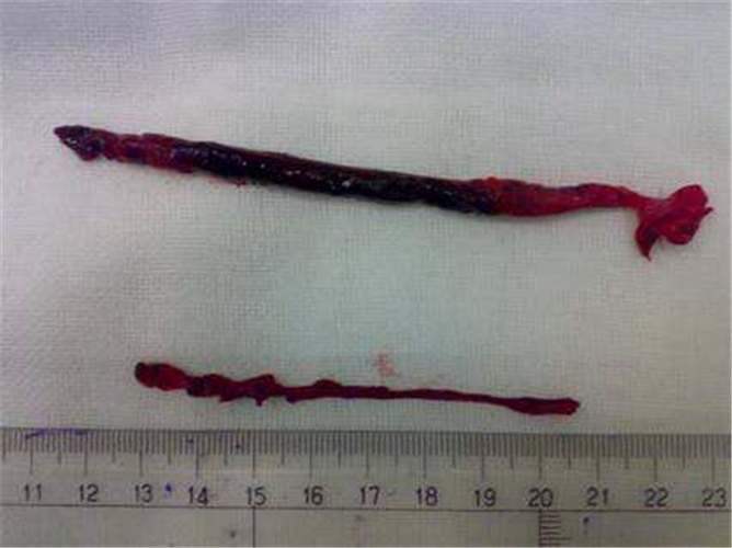 手術取出的腦血栓