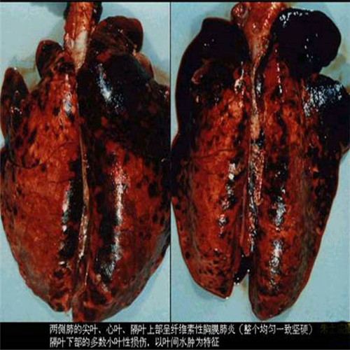 重度呼吸道感染肺部