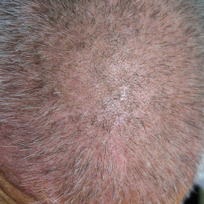 頭皮脂溢性皮炎 (35) 