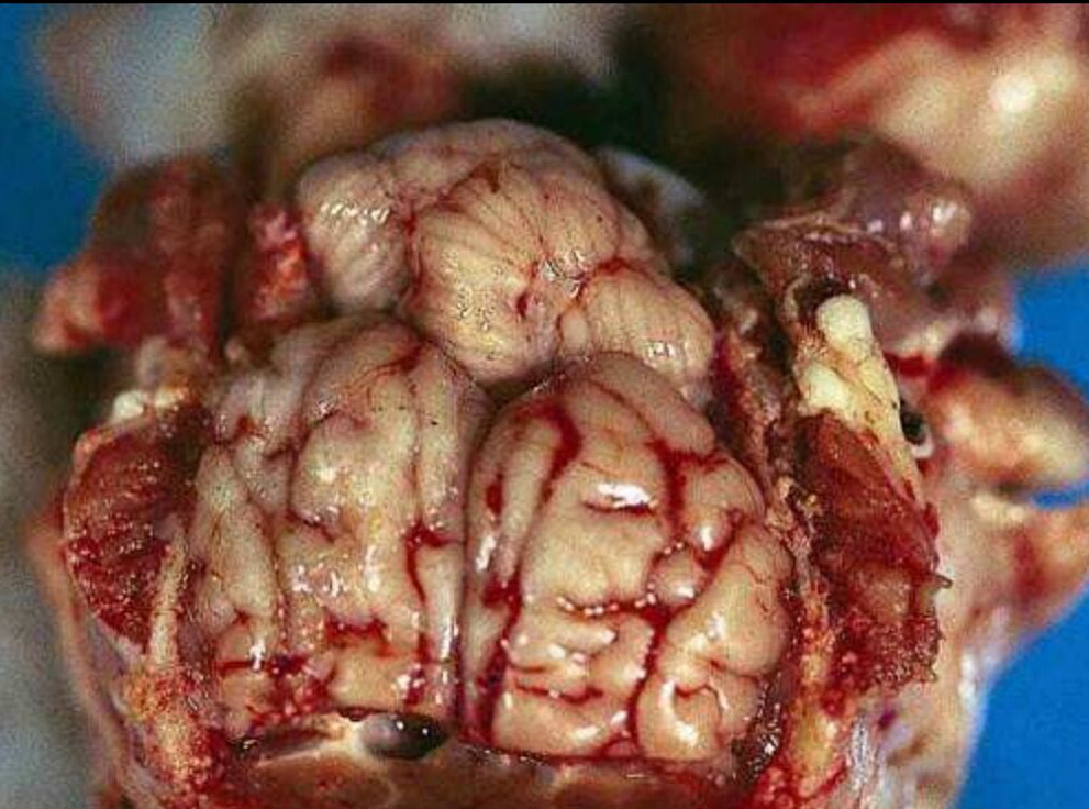 細菌性的腦膜炎的