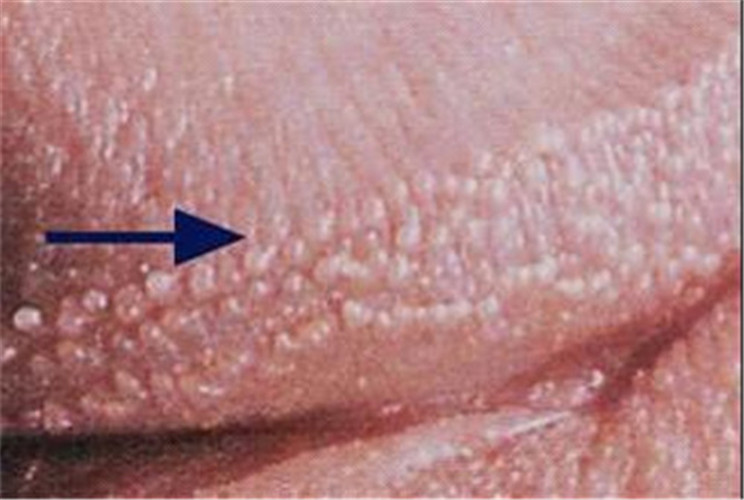 男性肉芽狀假性溼疣男