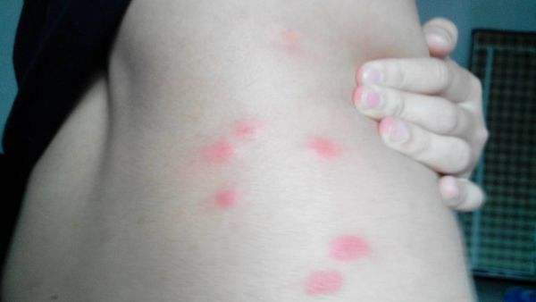 被跳蚤咬的症狀