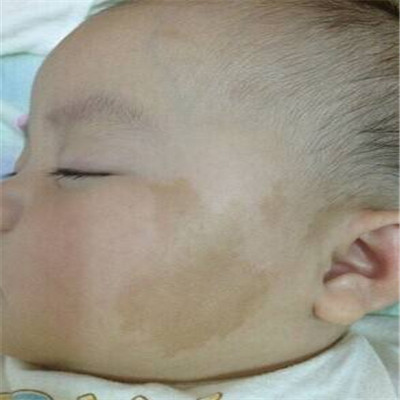 牛奶咖啡斑 (38) 