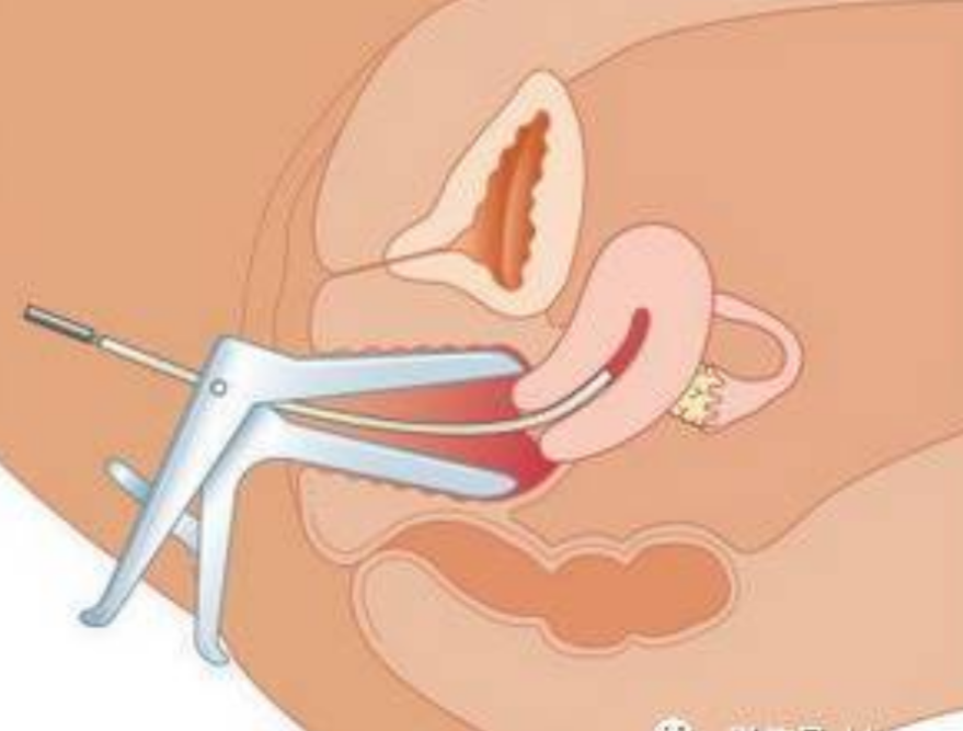 正常人工陰道的
