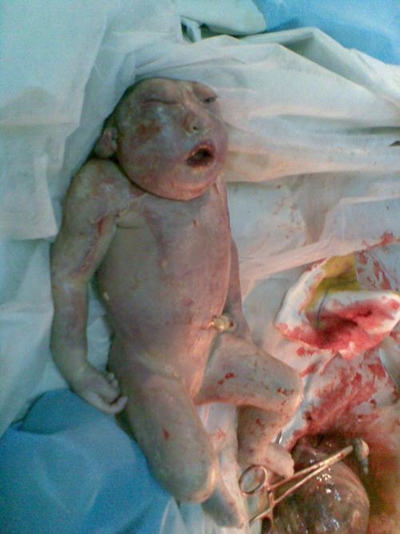 胎兒畸形 (49) 