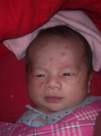 長水痘的症狀 (55) 