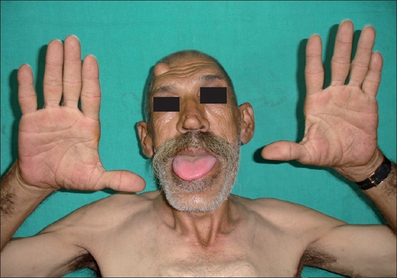 肢端肥大症  (40) 