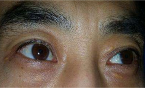 男人臉上長斑的