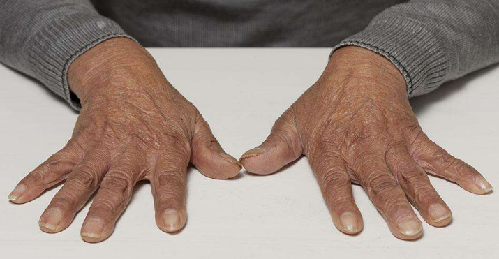 特發性震顫 (63) 