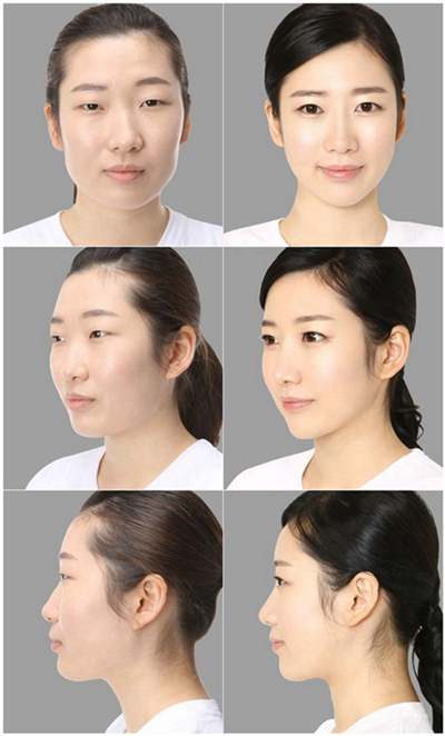 鼻子整形 (56) 