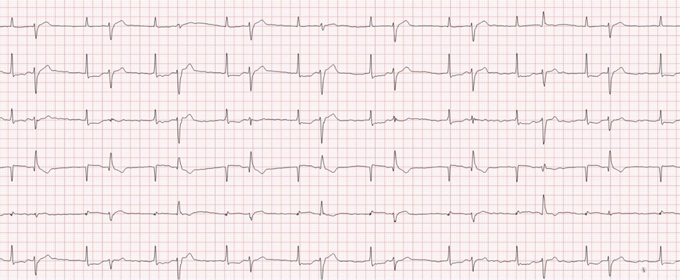 高鉀血癥心電圖 (5) 