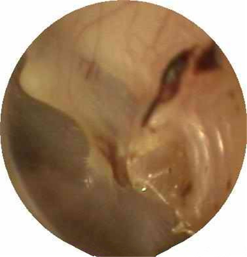外傷性的鼓膜穿孔