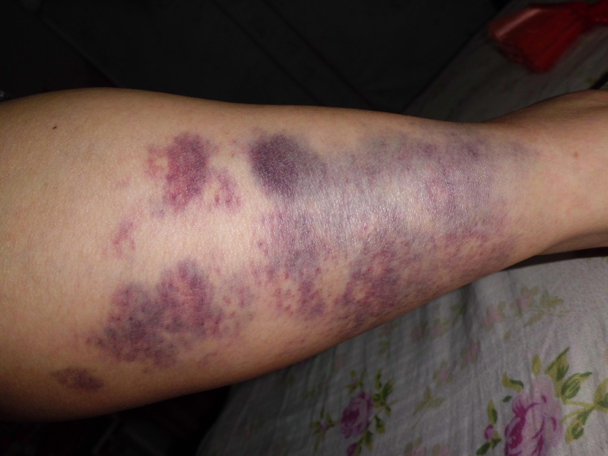 再生障礙性貧血腿部