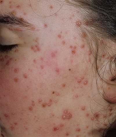 激素臉排毒症狀 (51) 