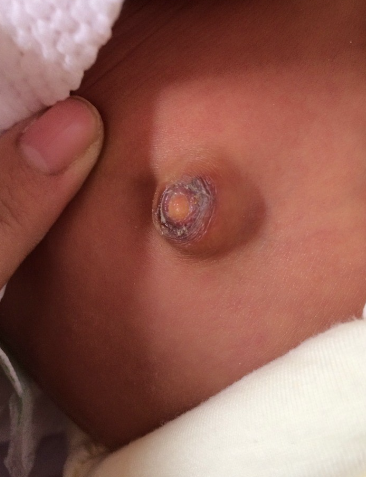 寶寶臍帶脫落後