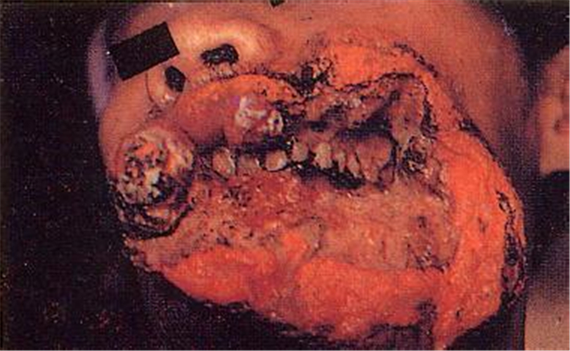 檳榔引起的頰癌